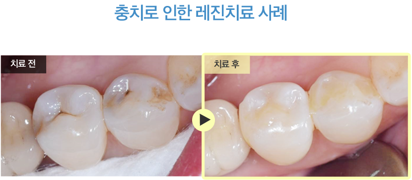 충치로 인한레진치료 사례