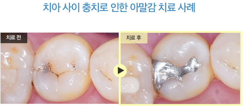 치아 사이 충치로 인한 아말감 치료 사례