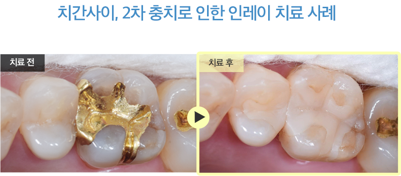 치간사이, 2차 충치로 인한 인레이 치료 사례