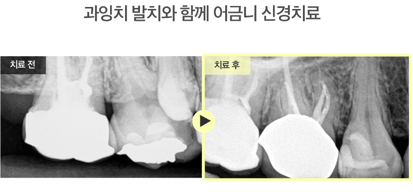 충치로 인한레진치료 사례