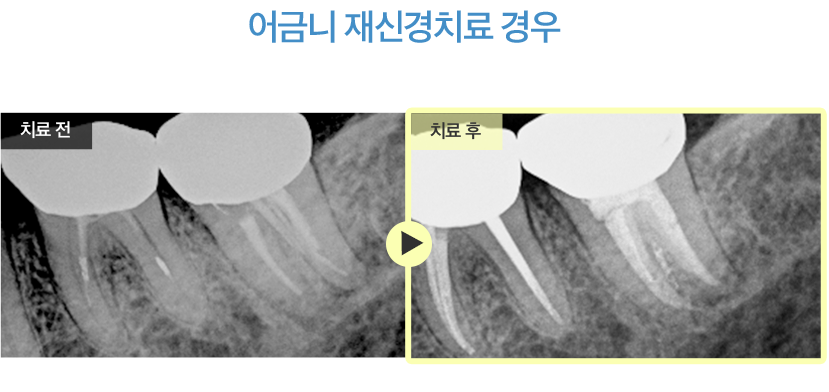 어금니 재신경치료 경우