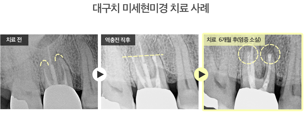 대구치 미세현미경 치료 사례