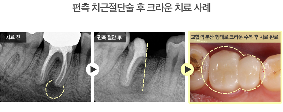 편측 치근절단술 후 크라운 치료 사례