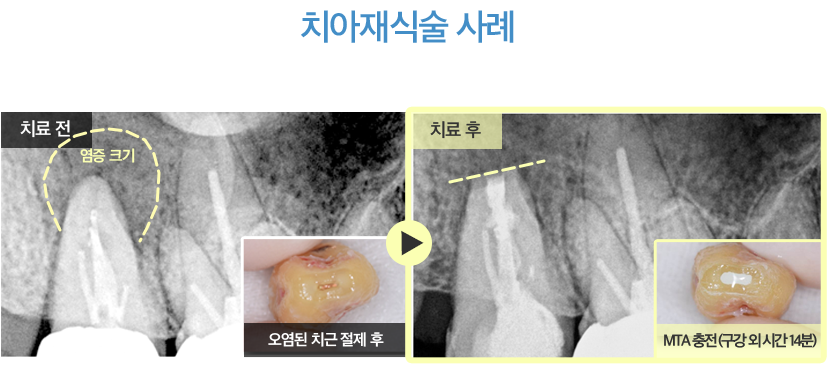 치아재식술 사례