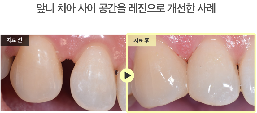 앞니 치아 사이 공간을 레진으로 개선한 사례