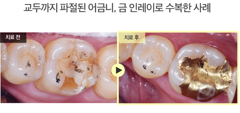 교두까지 파절된 어금니, 금 인레이로 수복한 사례