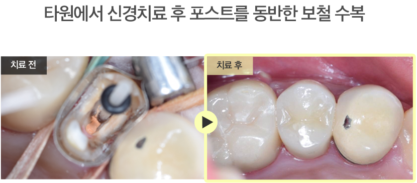 타원에서 신경치료 후 포스트를 동반한 보철 수복