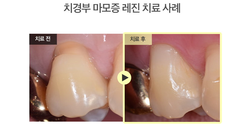 치경부 마모증 레진 치료 사례