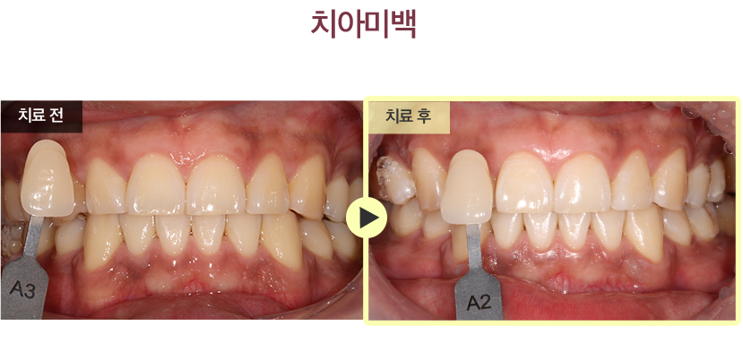 치아미백