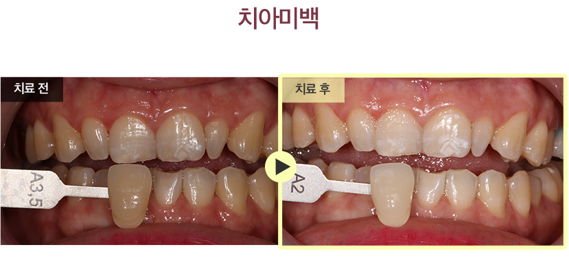 치아미백